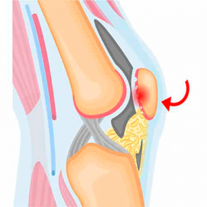 Condromalácia da Patela