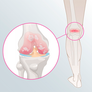 Gonartrose (artrose do joelho)