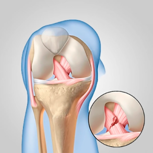 Lesões de ligamentos cruzados do joelho
