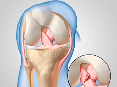 Lesoes-de-ligamentos-cruzados-do-joelho.png Lesoes-de-ligamentos-cruzados-do-joelho.png
