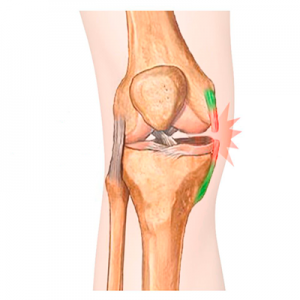 Lesões no joelho: ligamentos colaterais