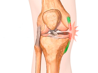 Lesoes-no-joelho-ligamentos-colaterais.png Lesoes-no-joelho-ligamentos-colaterais.png