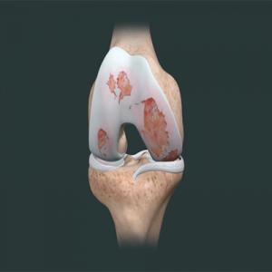Osteoartrite do Joelho