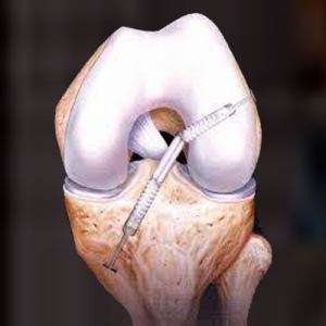 Reconstrução Ligamentar